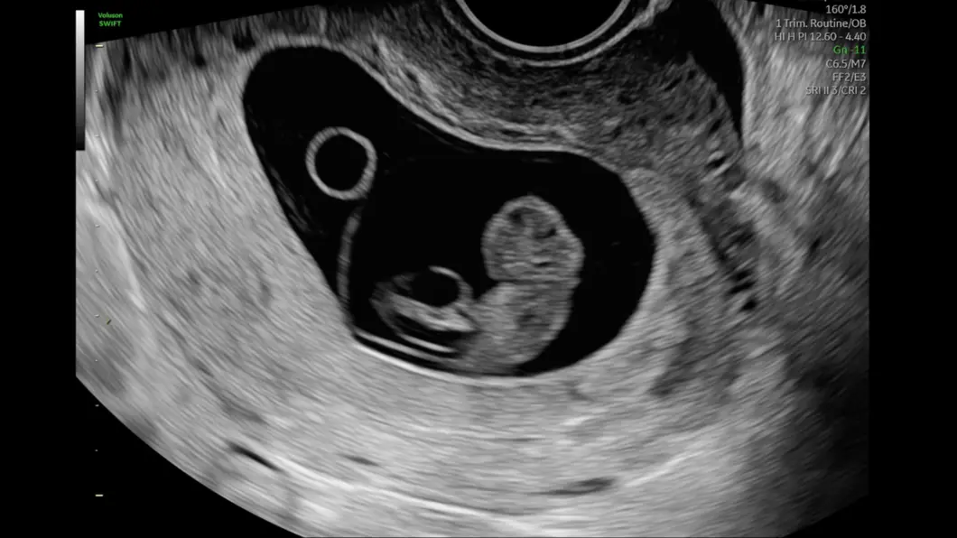 csm_9-week_fetus_2dd6551424