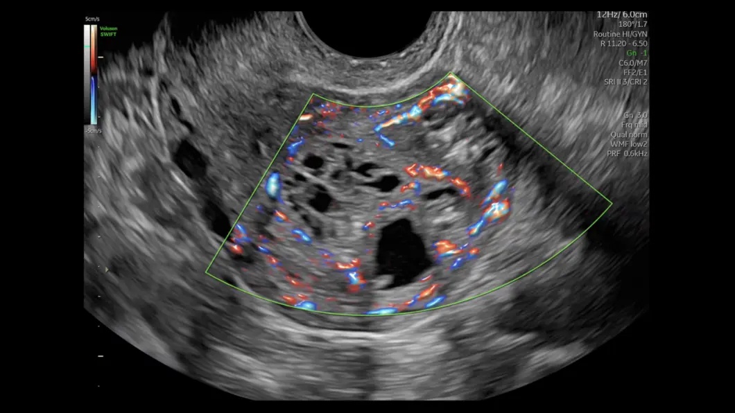 csm_RF_uterus_7b4c2c8ca1