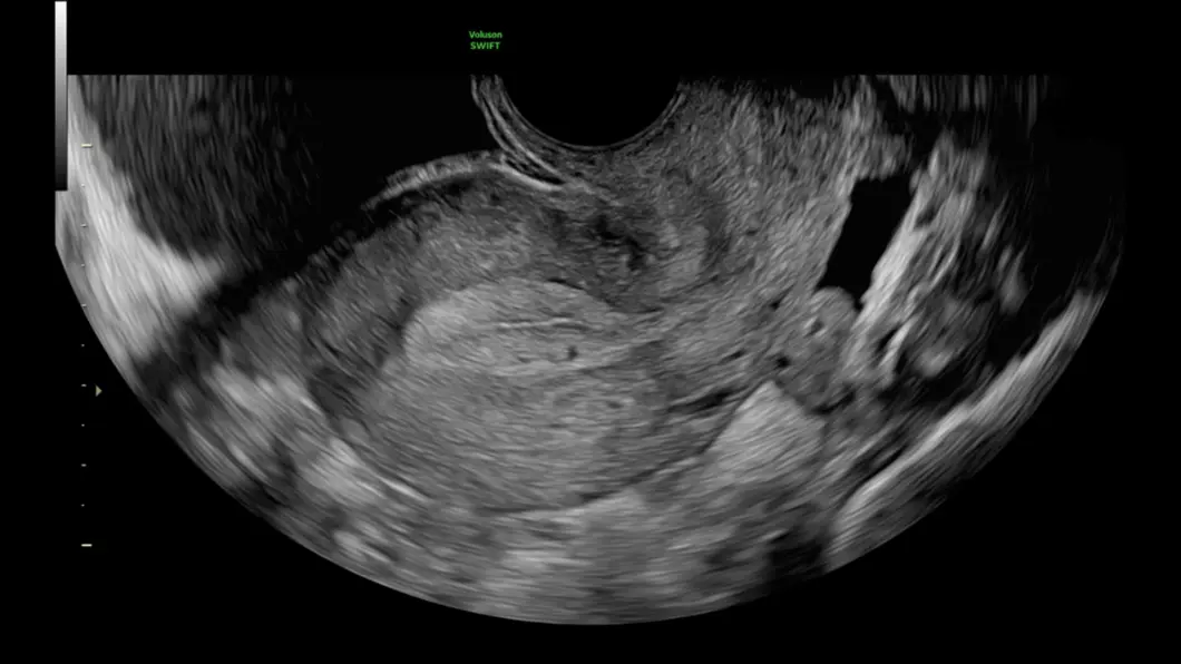 csm_normal_uterus_free_fluid_9cc6432248