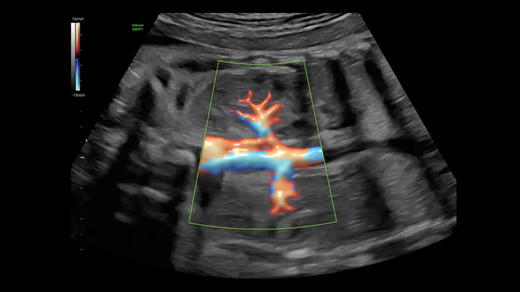 csm_rf_aota_kidney_875f8a9461