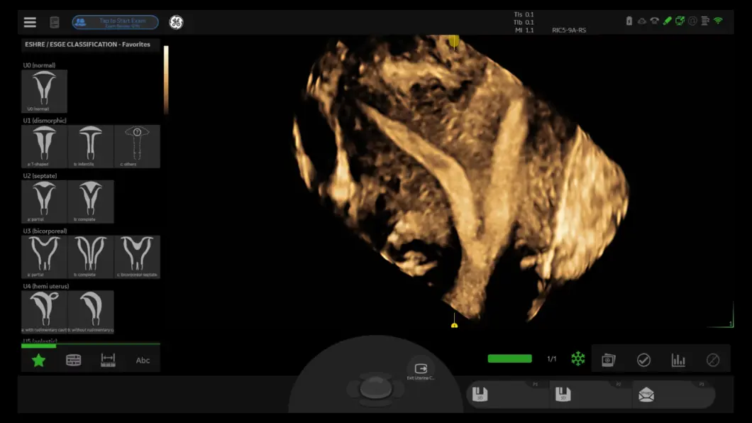 csm_septate_uterus_454ddb1984