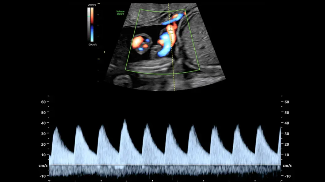 csm_umbilical_doppler_5565519eea